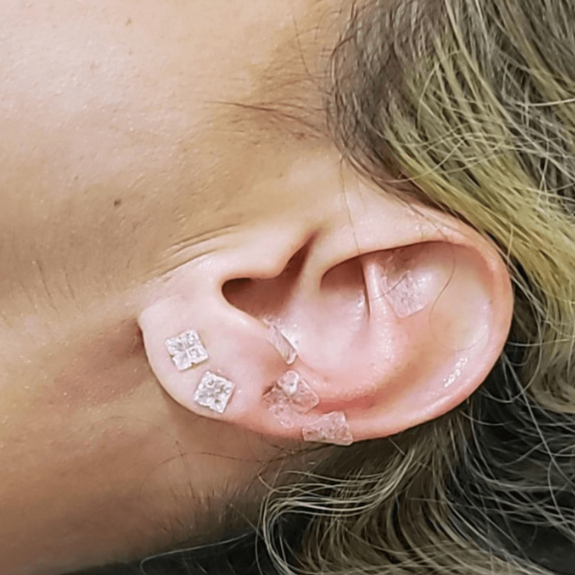 Auriculoterapia aplicada em orelha durante tratamento de acupuntura