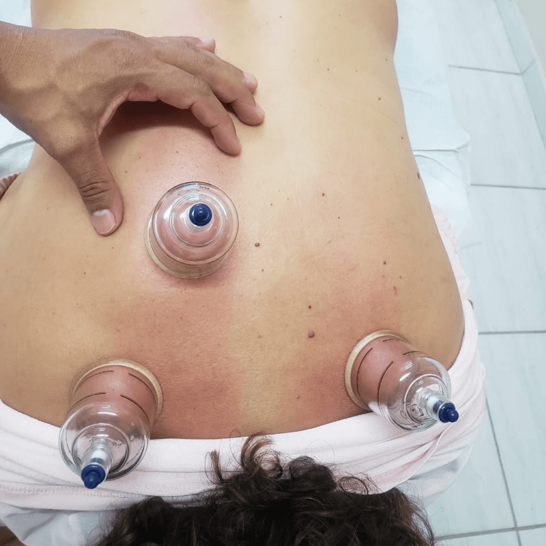 Ventosaterapia aplicada nas costas para relaxamento muscular